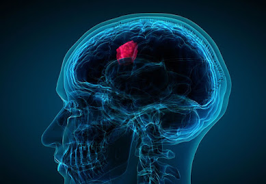 Brain Tumor